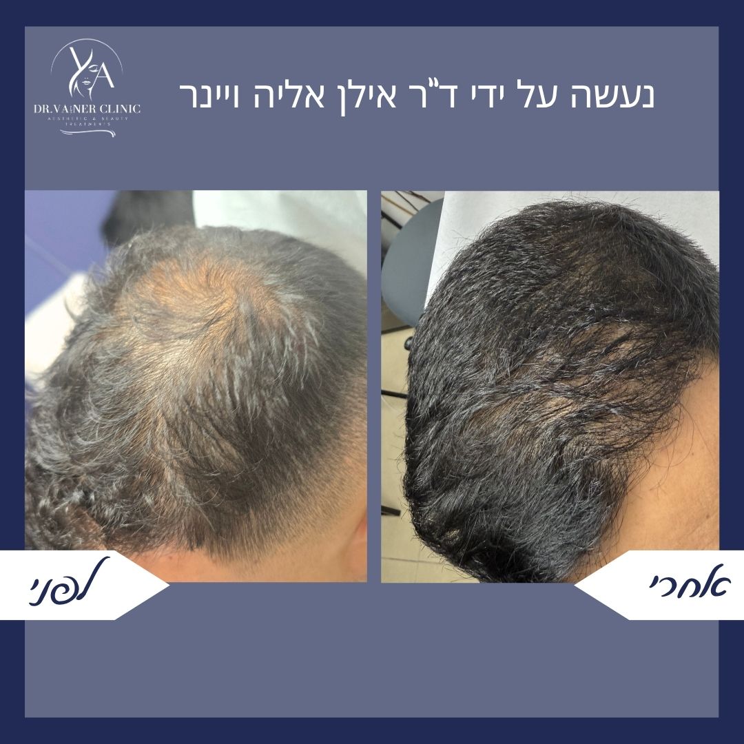 לפני ואחרי טיפול בהידללות בקדקוד
