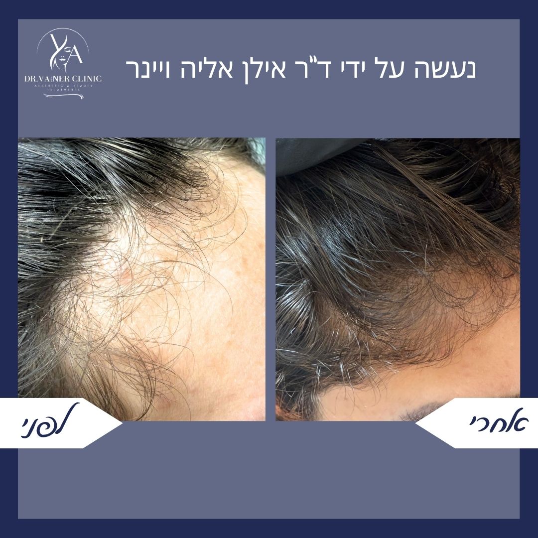 לפני ואחרי שיקום קו השיער הקדמי