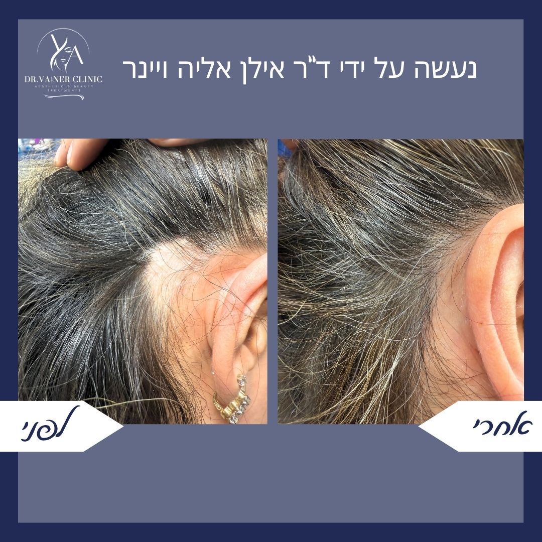 לפני ואחרי טיפול בנשירה מקומית באזור הרקה