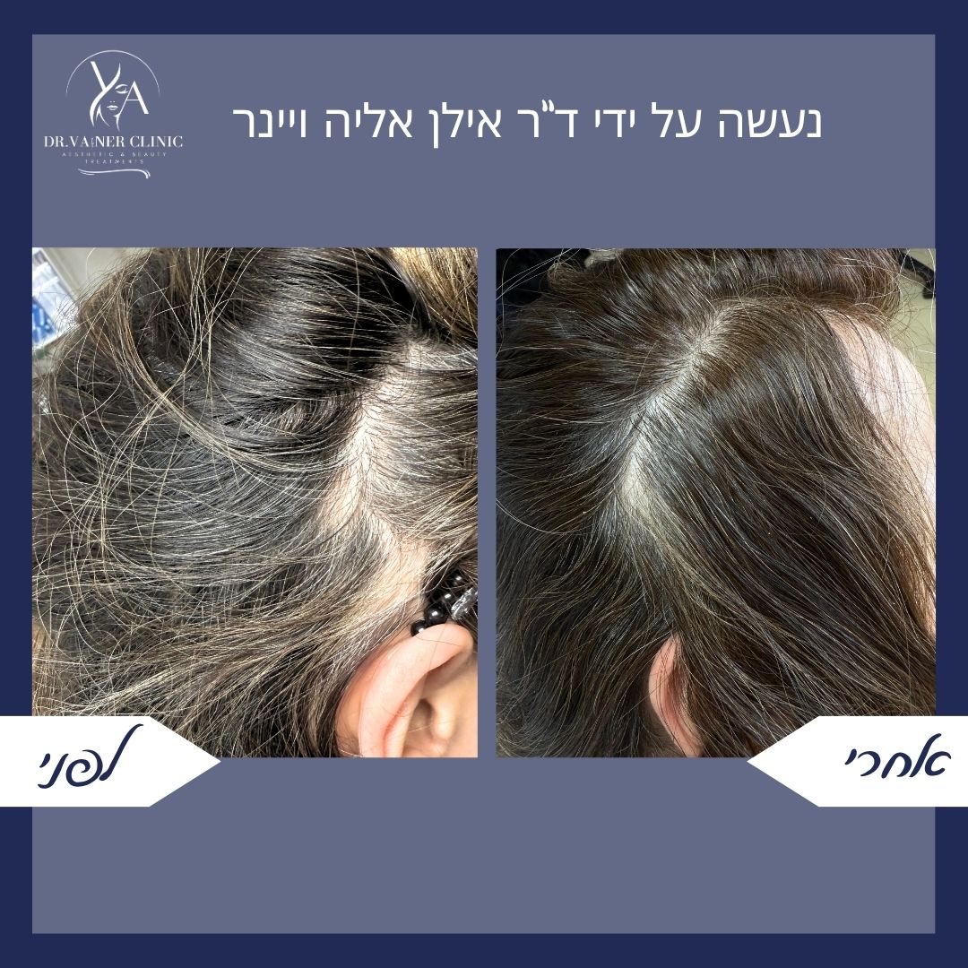 לפני ואחרי טיפול בדילול שיער אצל אישה