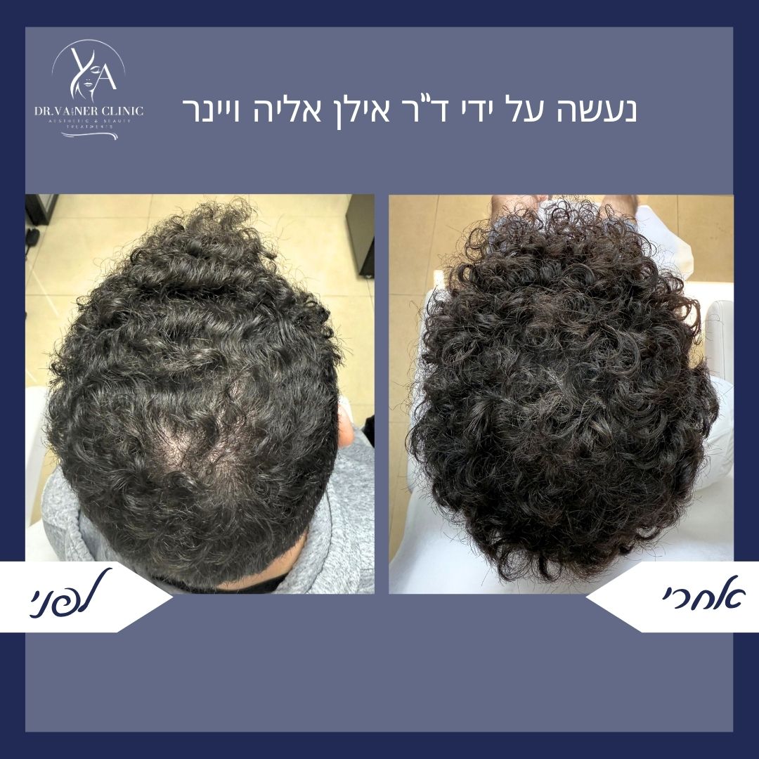 לפני ואחרי עיבוי שיער מתולתל בקדקוד