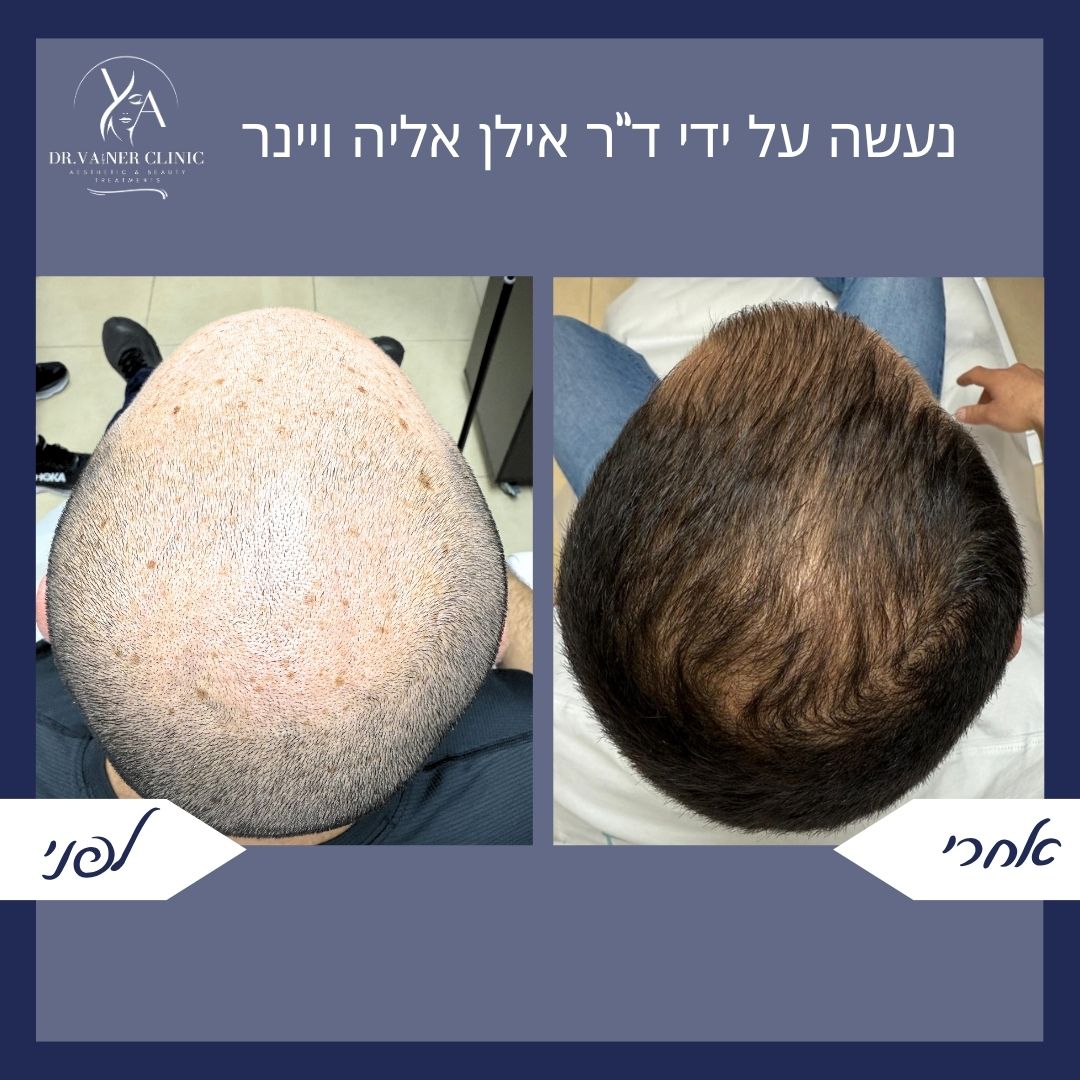 לפני ואחרי טיפול בהתקרחות בקדקוד אצל גבר