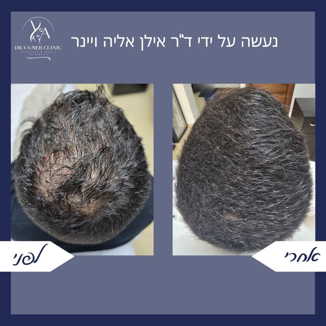 לפני ואחרי עיבוי שיער בקדקוד